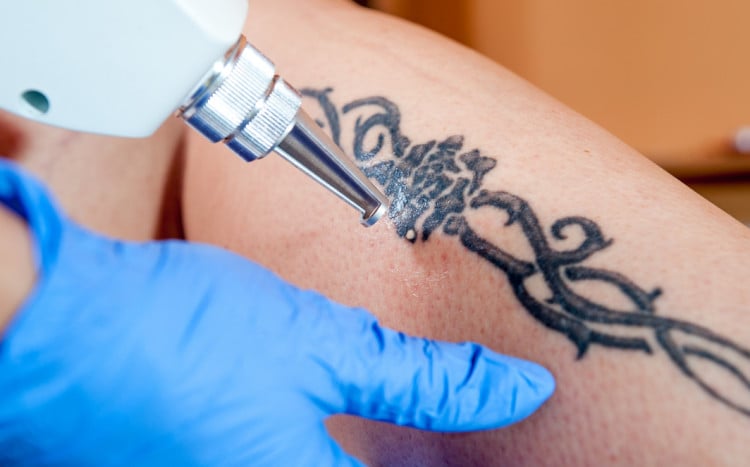 usuwanie tatuażu laserem